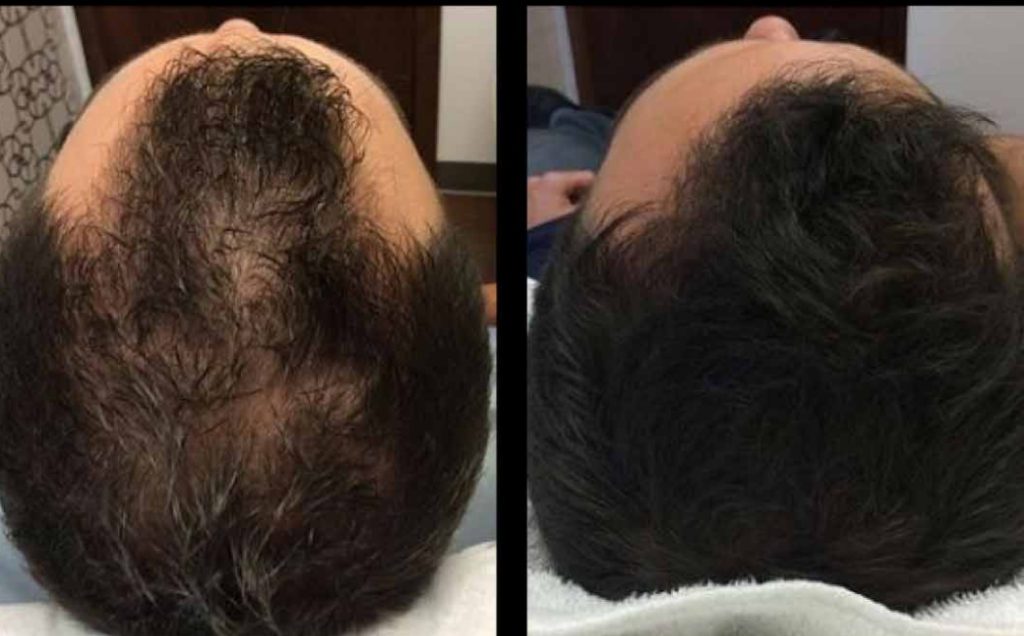 PRP and Stem Cell Treatments Being Studied for Hair Loss